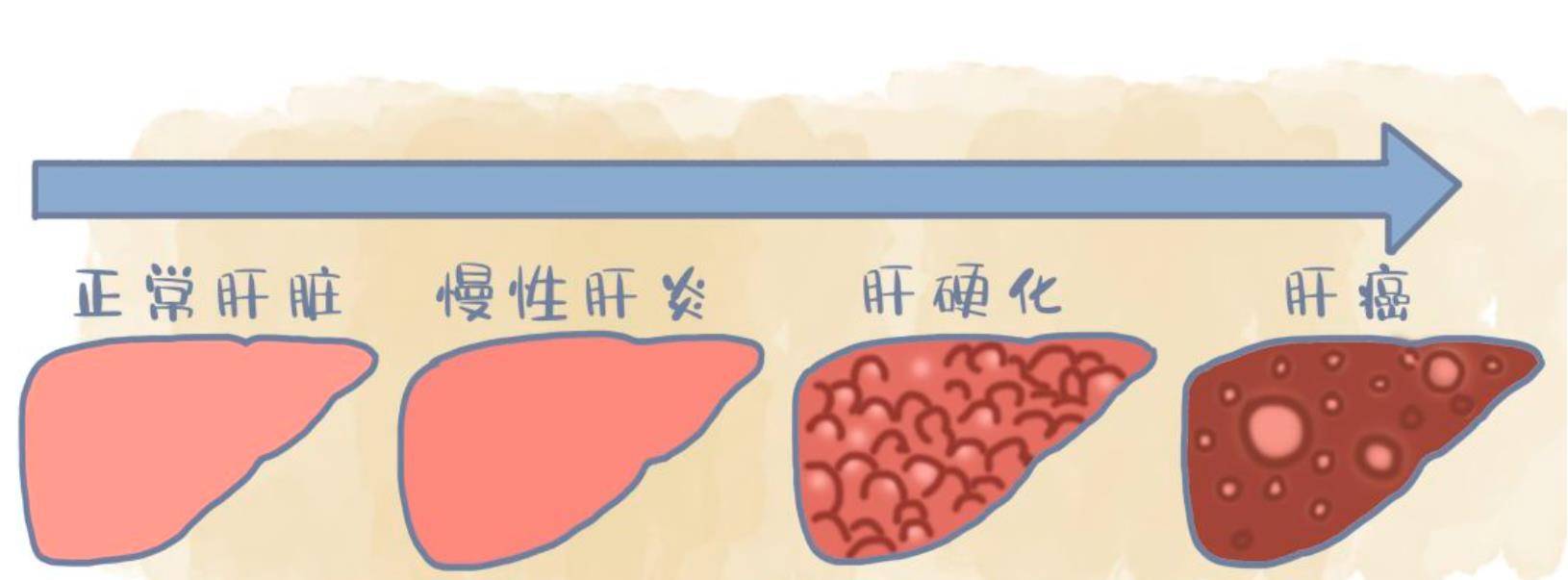 肝硬化研究与治疗的最新进展研究简述