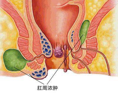 肛周脓肿初期最新治疗与护理方法解析