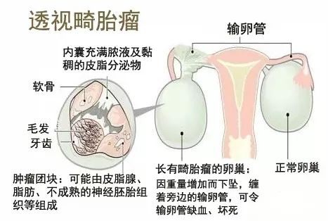 N窝囊肿的最新研究及治疗进展揭秘