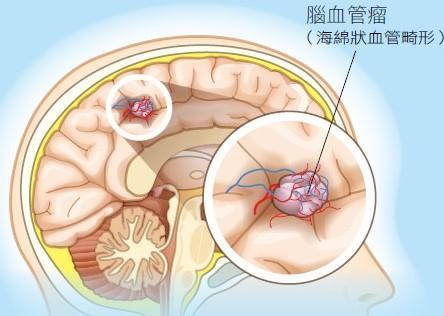 血管瘤初期研究及治疗进展的最新动态