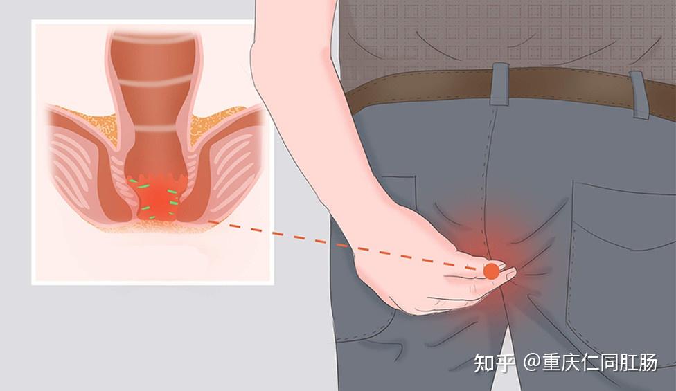 肛门肉球脱出，深入了解及最新治疗进展概述