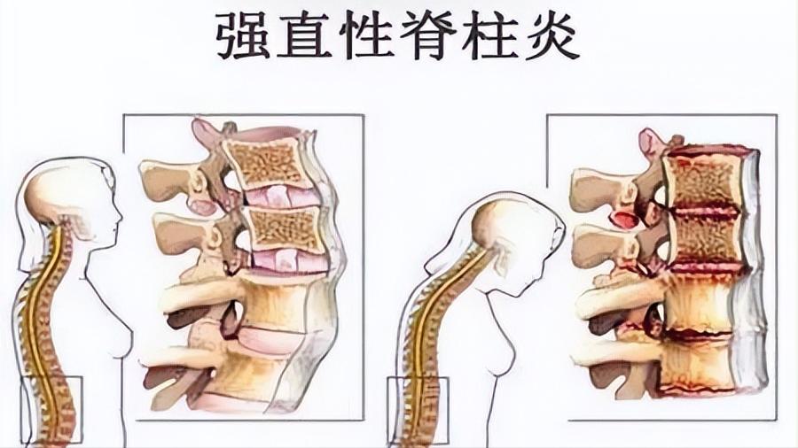 关于强直性脊柱炎的最新研究成果与市场影响解析