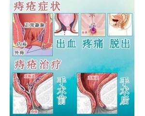 环境波动风险下尖锐湿疣早期症状重新认识与痔疮外痔最新治疗策略探究